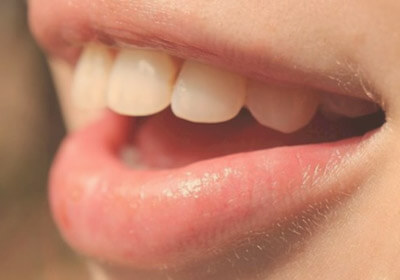 ortodoncia-mordida-abierta